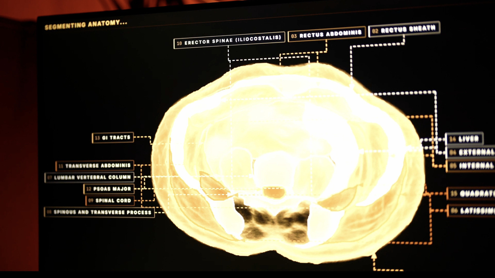 Midjourney 'Ultrasonic CT' anatomy-segmentation interface on a display