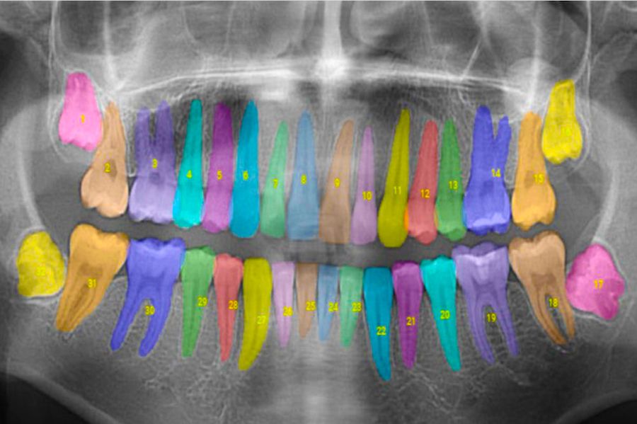 AI-assisted dental treatment